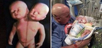 В США родилась девочка с двумя головами. Фото