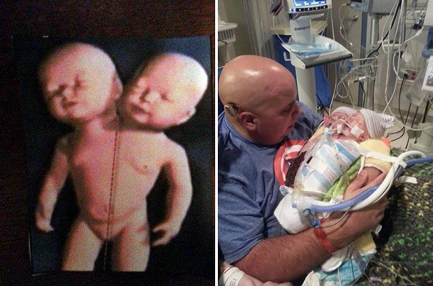 В США родилась девочка с двумя головами. Фото