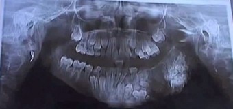 Семилетнему мальчику в Индии удалили 80 зубов. Фото