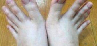 Аномально длинные пальцы ног взволновали пользователей сети. Фото