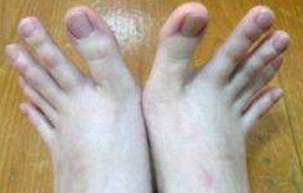 Аномально длинные пальцы ног взволновали пользователей сети. Фото